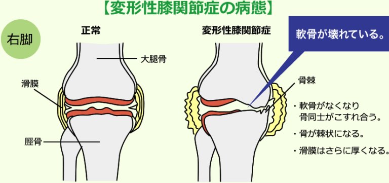 膝の病態の図