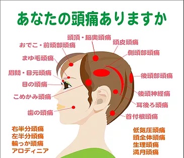 頭痛の種類の図